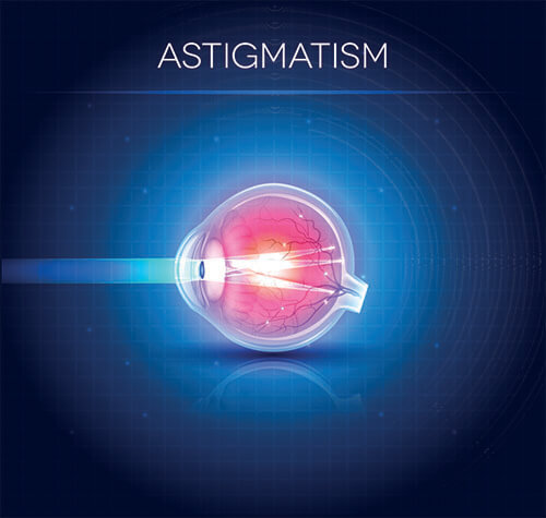How Astigmatism Affects an Eye