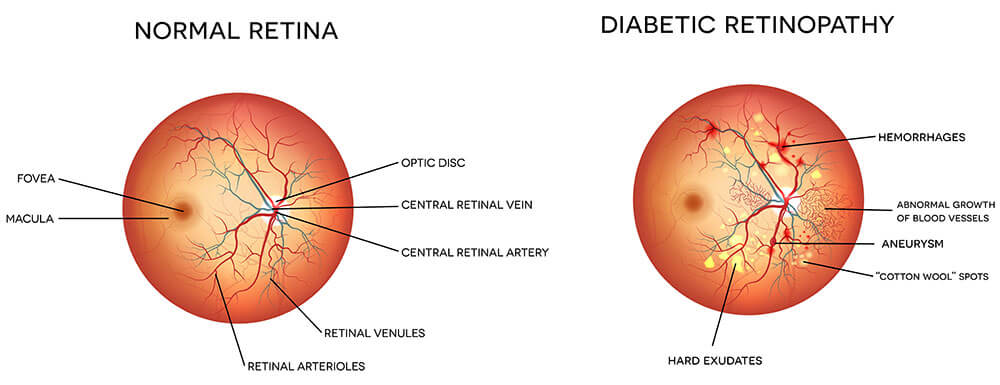 Chart Showing a Normal Retina Compared to One With Diabetic Retinopathy