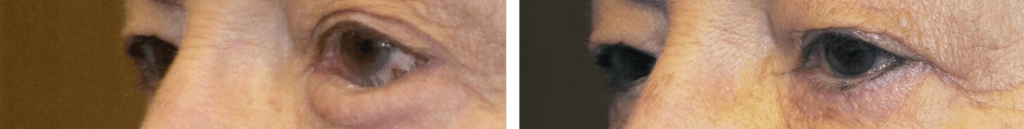 Before and After