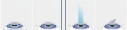 Chart Showing the LASIK Process