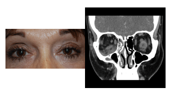 Left orbital mass (lacrimal gland lyphoma) presenting with ptosis