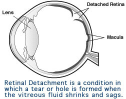 Retinal Detachment is a condition in which a tear or hole is formed when the vitreous fluid shrinks and sags